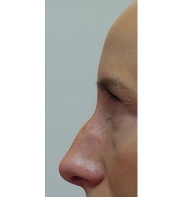 Rhinoplasty